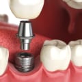 How much does the dental implant cost?