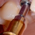 When to remove the dental implant?