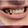 Can dental implants be done in one day?