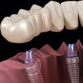 What type of dental implant is the best?