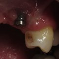 Can a defective dental implant be replaced?