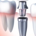 How much pain for dental implants?