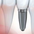 Definition of dental implant of whom?