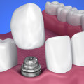 What causes dental implant failure?