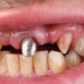 What are the long-term effects of dental implants?