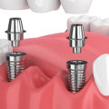 What dental implant is this?