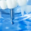 Who is not suitable for dental implants?