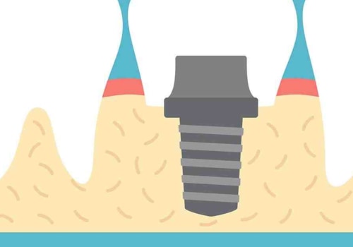 Do dental implants have serial numbers?