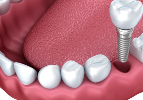 Are dental implants rejected?