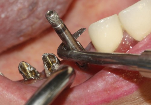 Can the screws be removed from dental implants?