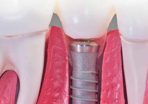 How common is the rejection of dental implants?