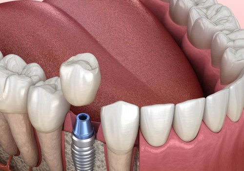 Are dental implants harmful?