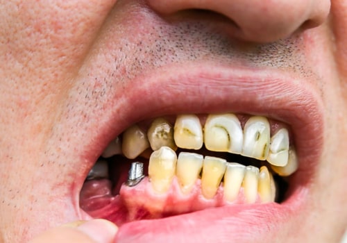 Do dental implants cause health problems?