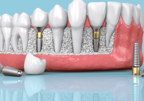 Do dental implants have an expiration date?