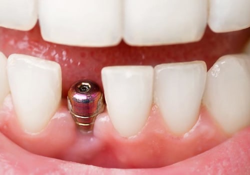 Can a dental implant be done in one day?