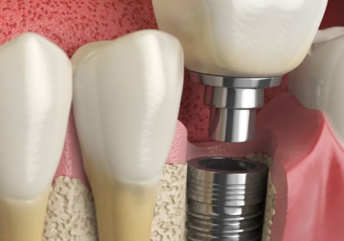What is the code for dental implants?