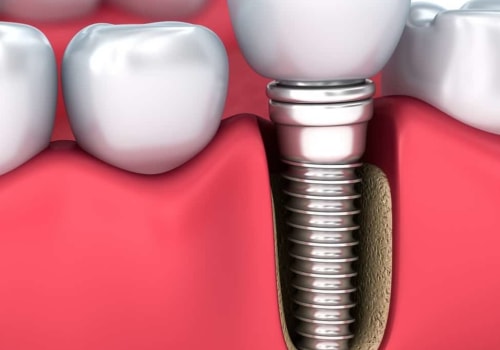 Are dental implants a bad idea?