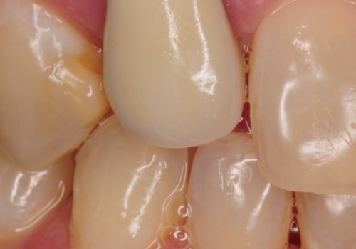 Can the dental implant be infected?