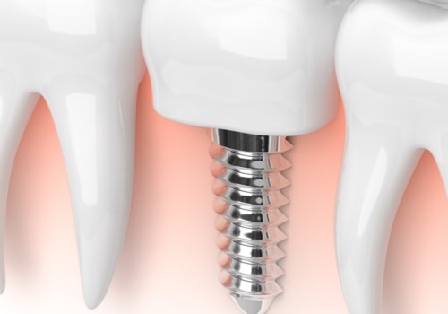 Are some dental implants better than others?