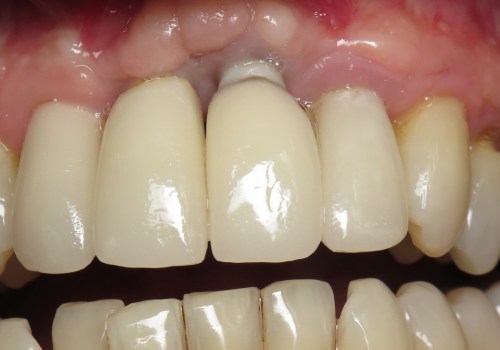 Can you say that dental implants are fake?