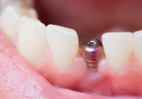 What is dental implant surgery?