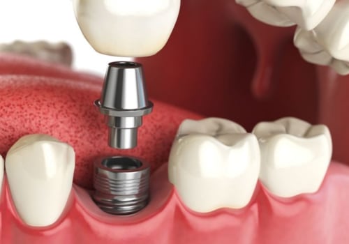How much does the dental implant cost?