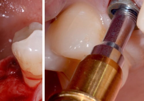 When to remove the dental implant?