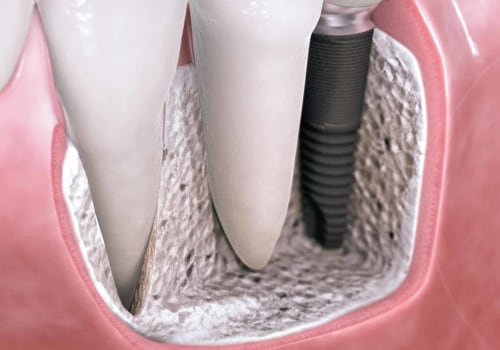 What does the dental implant look like?