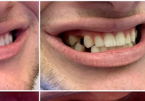Can dental implants be done in one day?