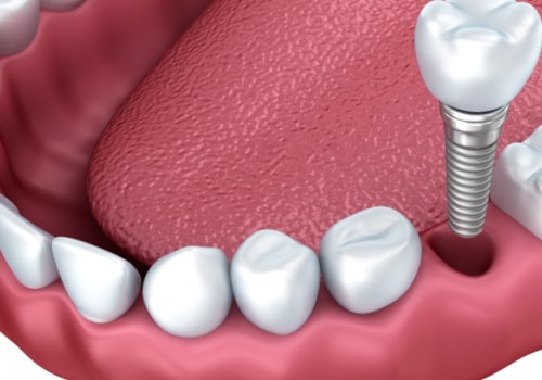 How do you know if your body is rejecting a dental implant?