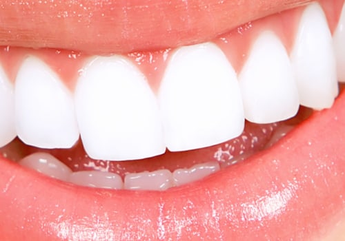 What is the cost of dental implants in India?