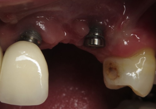 What happens when the dental implant fails?