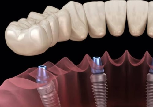 What type of dental implant is the best?