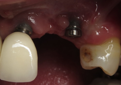 Can a defective dental implant be replaced?