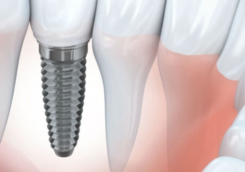Definition of dental implant of whom?