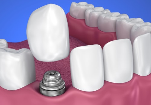 What causes dental implant failure?