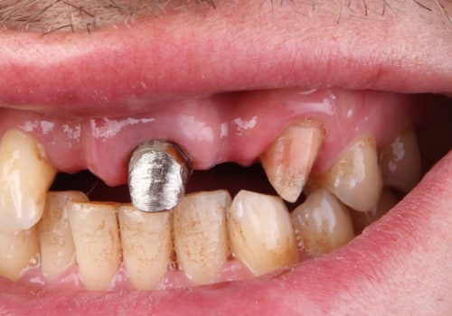 What are the long-term effects of dental implants?