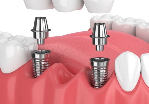 What dental implant is this?