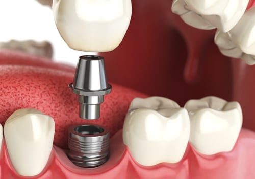 Are dental implants medically necessary?