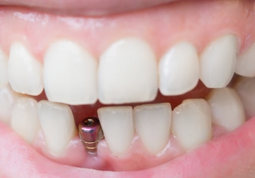 How much does a dental implant cost for a tooth?