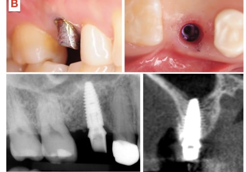 Why should a dental implant never be placed?